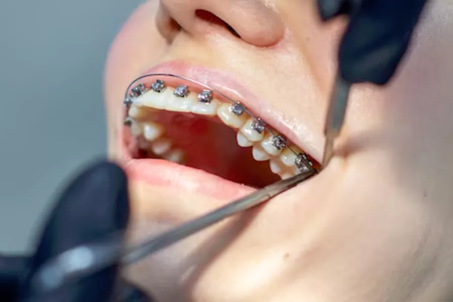 ارتودنسی براکت ثابت (معمولی)