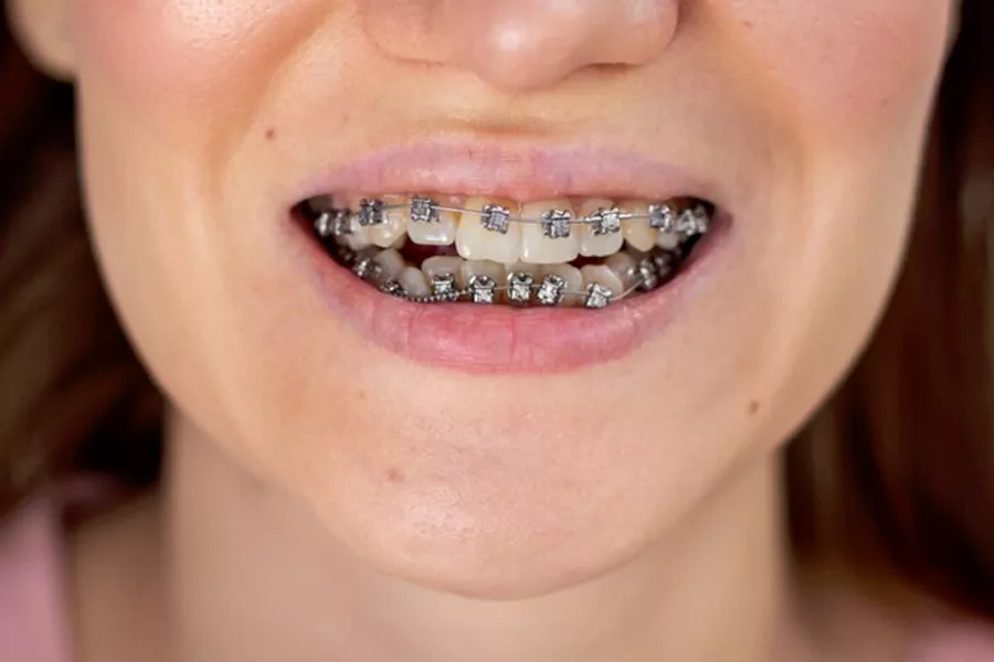 چه زمانی به ارتودنسی نیاز داریم؟