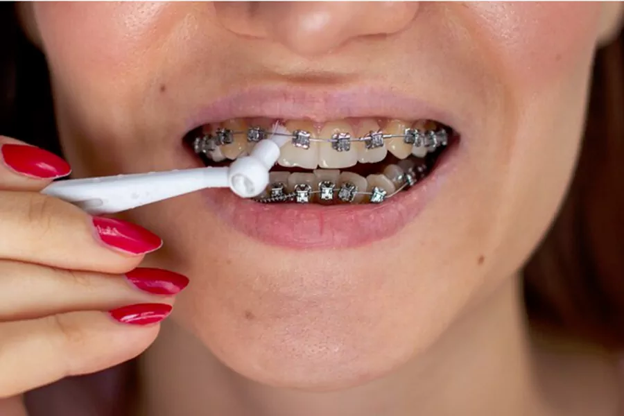 مراقبتهای بعد از ارتودنسی