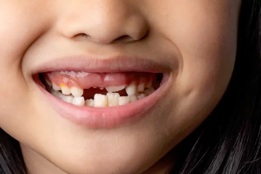 مناسب‌ ترین سن برای کامپوزیت دندان