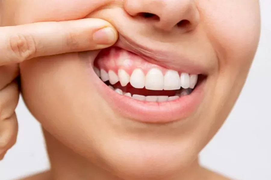 باندینگ دندان