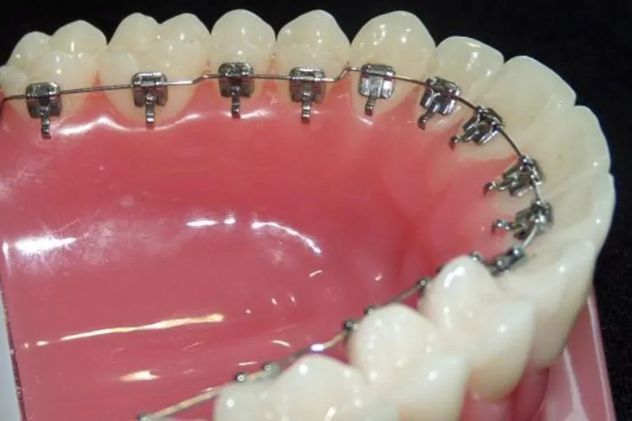 براکتهای توربو یا پشت دندانی