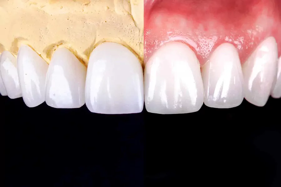 کاربرد های لمینت دندان